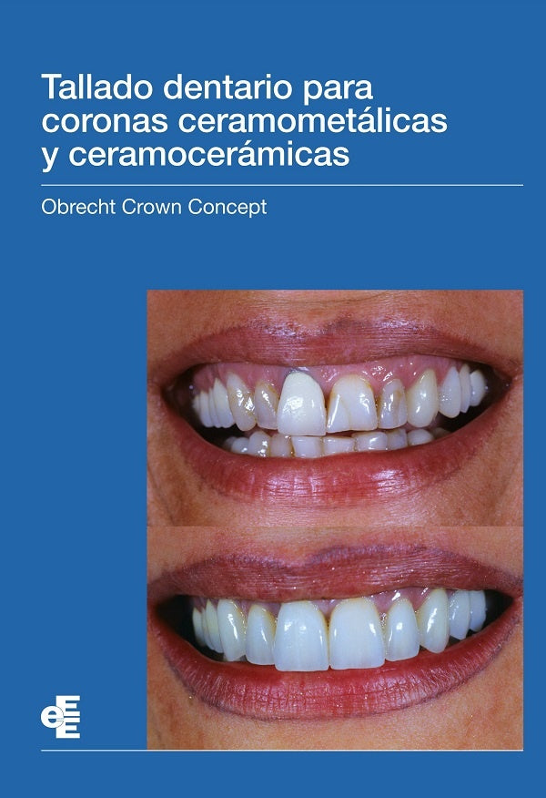 Tallado dentario para coronas ceramometalicas y ceramoceramicas | Marc Obrecht
