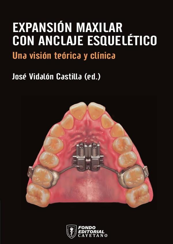 Expansion maxilar con anclaje esqueletico | Jose Antonio Vidalon Castilla