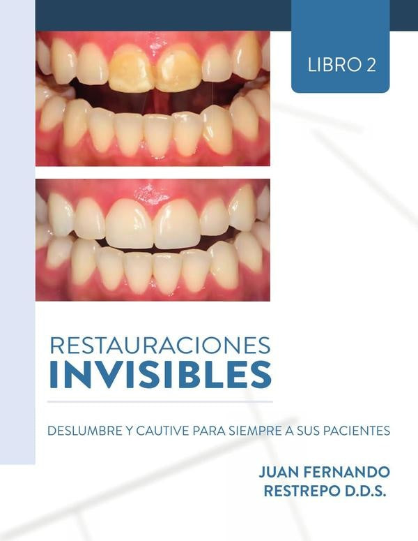 Restauraciones Invisibles: Deslumbre Y Cautive Para Siempre A Sus Pacientes | JUAN FERNANDO RESTREPO D.D.S.