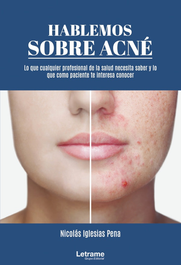 Hablemos sobre acne | Nicolas Iglesias Pena
